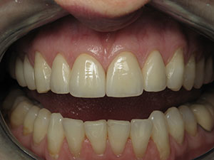 After Natural Esthetic Dental Crowns Treatment in North Dallas