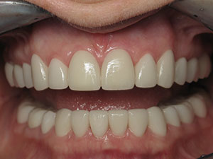 After Full Mouth Esthetic crowns treatment at Dale Greer DDS, Inc.