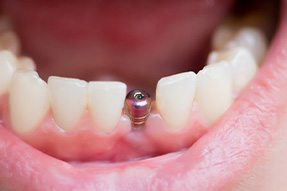 Dental implant in gum